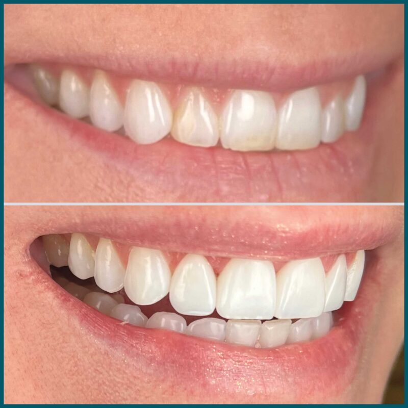 Day One Dentistry Before and After Photo 1