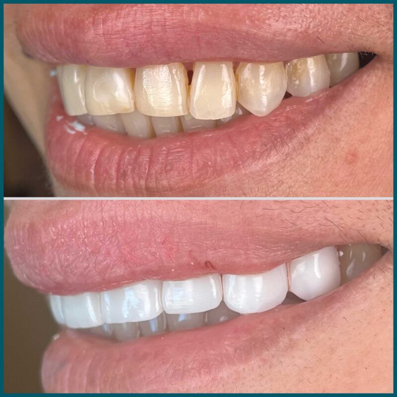 Day One Dentistry Before and After Photo 2