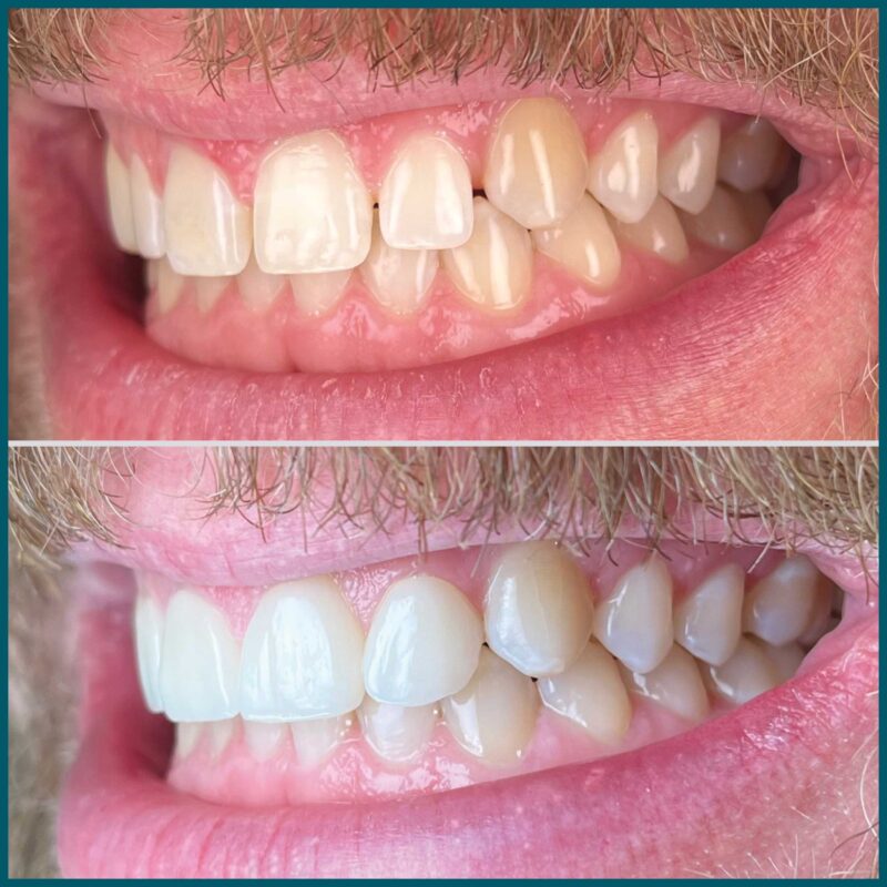 Day One Dentistry Before and After Photo 4