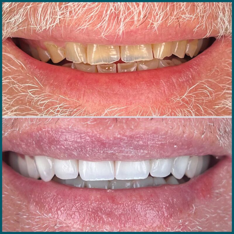 Day One Dentistry Before and After Photo 5